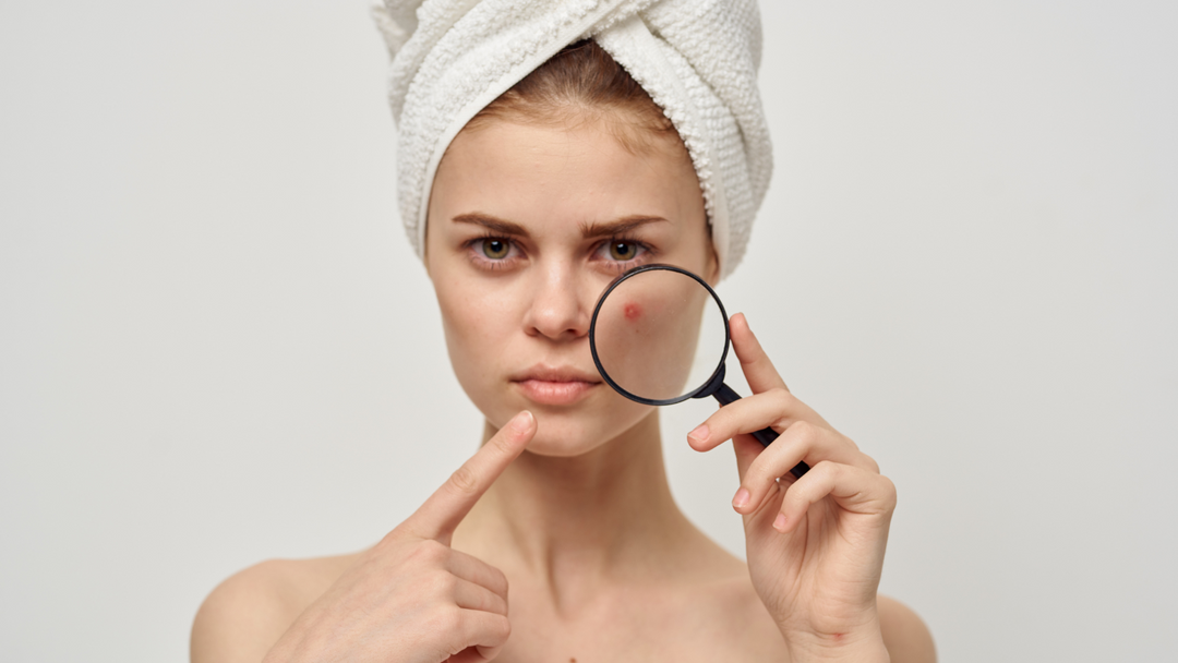 The Beauty of Clear Skin: Handmade Soap for Acne-Prone Skin