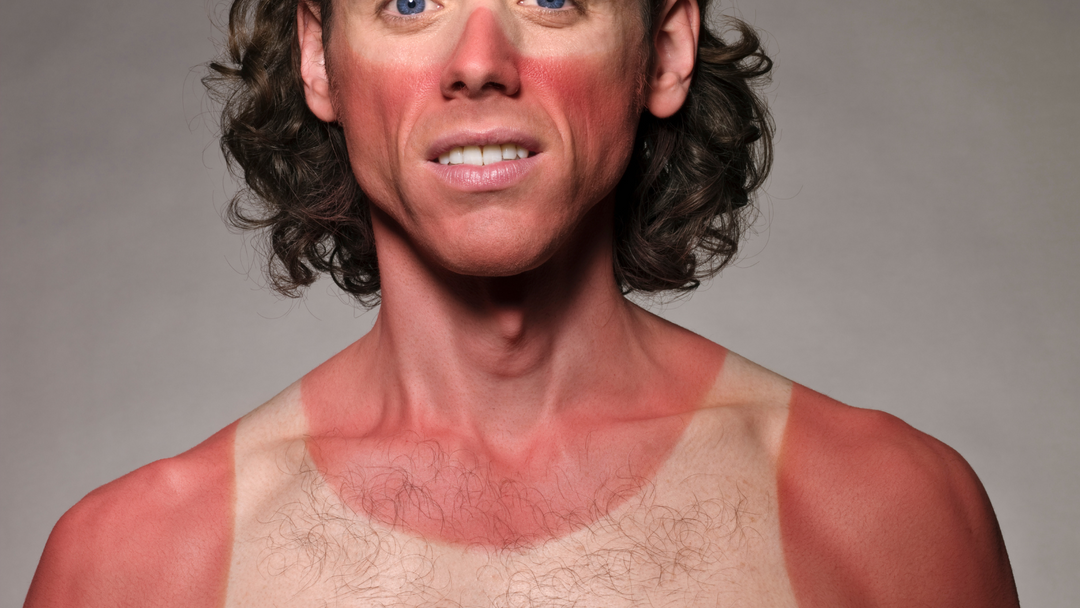 Sunburn. Prevent & Help