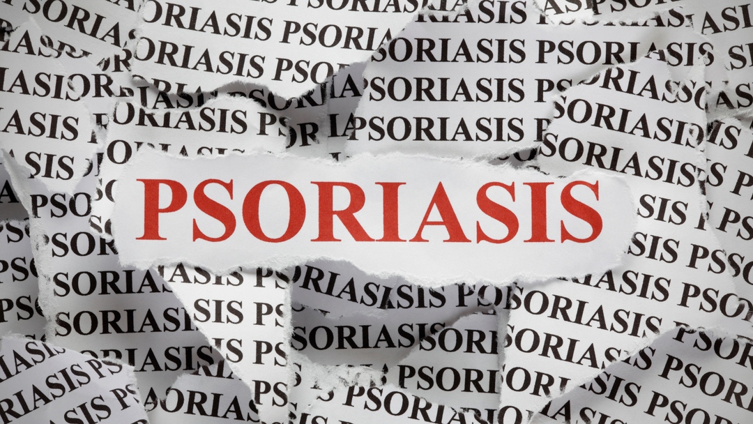 Psoriasis. Dos And Don`ts